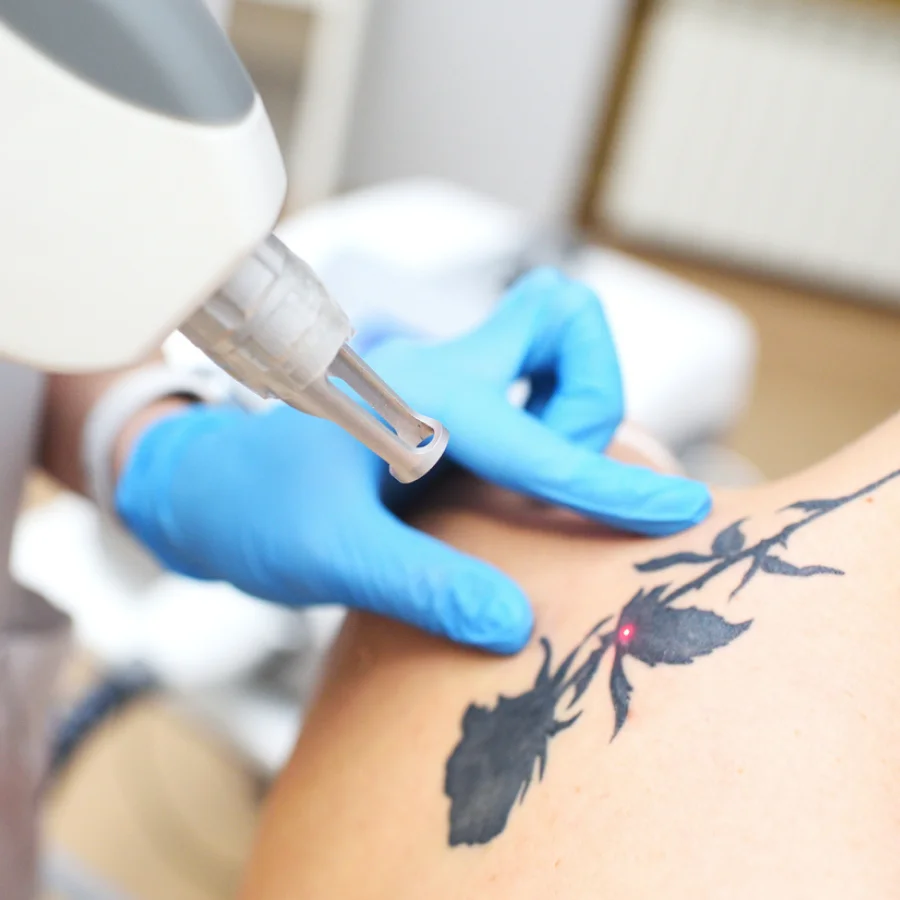 tattoo removal footer cta